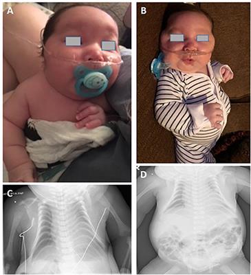 A Male Case of Kagami-Ogata Syndrome Caused by Paternal Unipaternal Disomy 14 as a Result of a Robertsonian Translocation